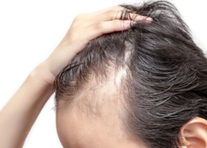 No Instituto Shalon oferecemos soluções eficazes para alopecia, causada por fatores genéticos, desequilíbrios hormonais, inflamações e estresse crônico.