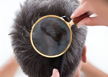 Alopecia - Tratamentos Alopecia - Tratamentos